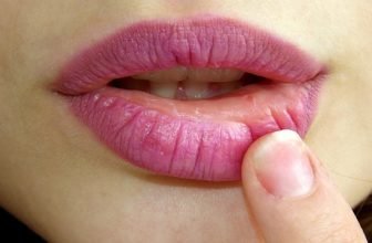 Waarom je een lipflip kunt overwegen voor vollere lippen